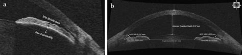 iris thickness measurement|how thick are eye numbers.